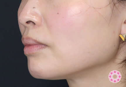 年代：30代 施術名：エラ取り（ボトックス） 施術前｜【公式】東京形成美容外科