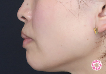 年代：30代 施術名：エラ取り（ボトックス） 施術前｜【公式】東京形成美容外科