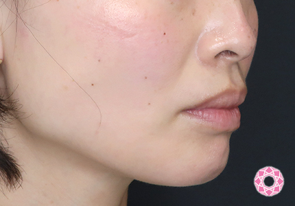 年代：30代 施術名：エラ取り（ボトックス） 施術前｜【公式】東京形成美容外科