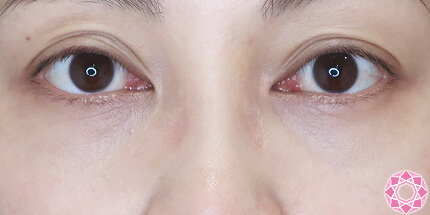 年代：30代 施術名：目の下のふくらみ取り 施術後｜【公式】東京形成美容外科