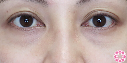 年代：30代 施術名：目の下のふくらみ取り 施術前｜【公式】東京形成美容外科