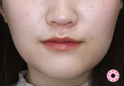 年代：20代 施術名：エラ取り（ボトックス） 施術後｜【公式】東京形成美容外科