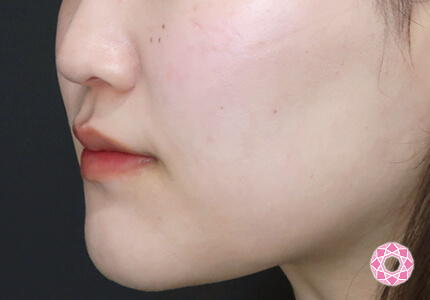 年代：20代 施術名：エラ取り（ボトックス） 施術後｜【公式】東京形成美容外科