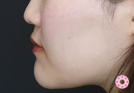 年代：20代 施術名：エラ取り（ボトックス） 施術後｜【公式】東京形成美容外科