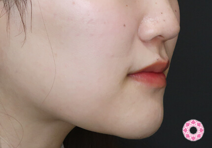 年代：20代 施術名：エラ取り（ボトックス） 施術後｜【公式】東京形成美容外科