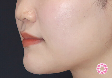 年代：20代 施術名：エラ取り（ボトックス） 施術前｜【公式】東京形成美容外科