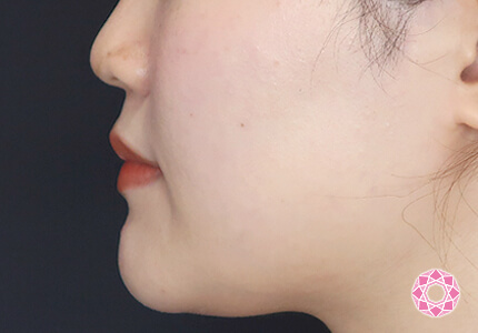 年代：20代 施術名：エラ取り（ボトックス） 施術前｜【公式】東京形成美容外科