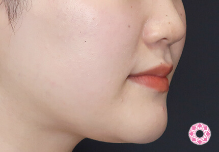 年代：20代 施術名：エラ取り（ボトックス） 施術前｜【公式】東京形成美容外科