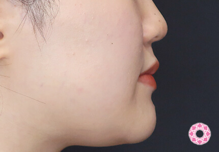 年代：20代 施術名：エラ取り（ボトックス） 施術前｜【公式】東京形成美容外科