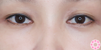 年代：40代 施術名：目の下のふくらみ取り 施術後｜【公式】東京形成美容外科