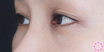 年代：40代 施術名：目の下のふくらみ取り 施術後｜【公式】東京形成美容外科