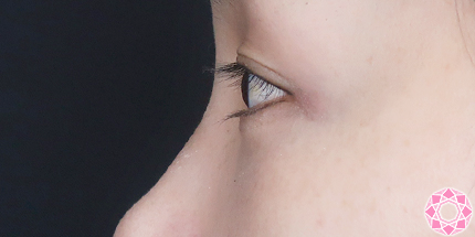 年代：40代 施術名：目の下のふくらみ取り 施術後｜【公式】東京形成美容外科