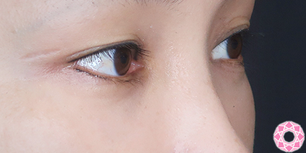 年代：40代 施術名：目の下のふくらみ取り 施術後｜【公式】東京形成美容外科