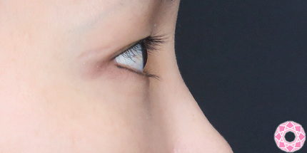 年代：40代 施術名：目の下のふくらみ取り 施術後｜【公式】東京形成美容外科