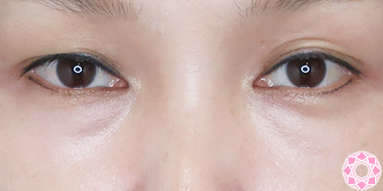 年代：40代 施術名：目の下のふくらみ取り 施術前｜【公式】東京形成美容外科