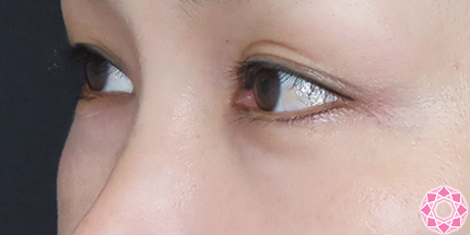 年代：40代 施術名：目の下のふくらみ取り 施術前｜【公式】東京形成美容外科