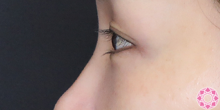 年代：40代 施術名：目の下のふくらみ取り 施術前｜【公式】東京形成美容外科