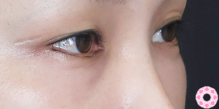 年代：40代 施術名：目の下のふくらみ取り 施術前｜【公式】東京形成美容外科