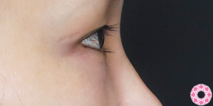 年代：40代 施術名：目の下のふくらみ取り 施術前｜【公式】東京形成美容外科