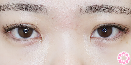 年代：20代 施術名：二重埋没法 施術後｜【公式】東京形成美容外科