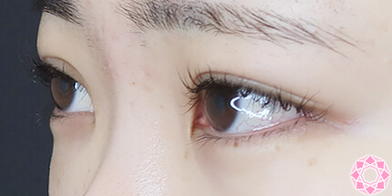 年代：20代 施術名：二重埋没法 施術後｜【公式】東京形成美容外科