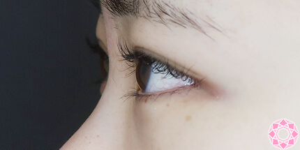 年代：20代 施術名：二重埋没法 施術後｜【公式】東京形成美容外科