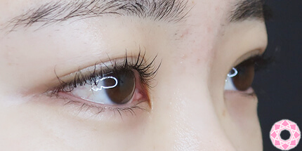 年代：20代 施術名：二重埋没法 施術後｜【公式】東京形成美容外科