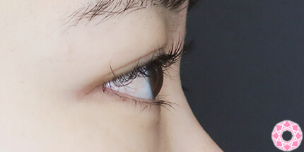 年代：20代 施術名：二重埋没法 施術後｜【公式】東京形成美容外科