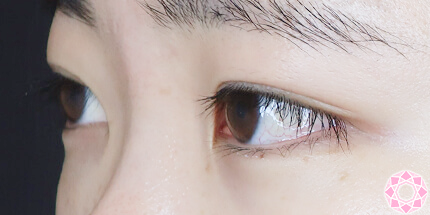 年代：20代 施術名：二重埋没法 施術前｜【公式】東京形成美容外科