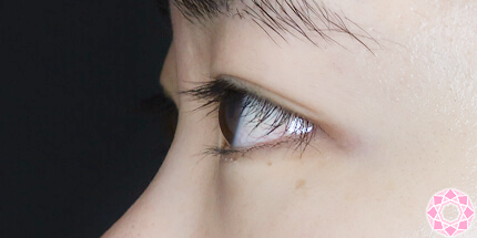 年代：20代 施術名：二重埋没法 施術前｜【公式】東京形成美容外科