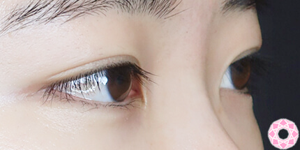 年代：20代 施術名：二重埋没法 施術前｜【公式】東京形成美容外科