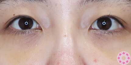 年代：20代 施術名：目の下のふくらみ取り 施術後｜【公式】東京形成美容外科