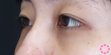 年代：20代 施術名：目の下のふくらみ取り 施術後｜【公式】東京形成美容外科