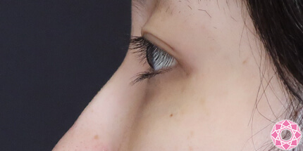 年代：20代 施術名：目の下のふくらみ取り 施術後｜【公式】東京形成美容外科