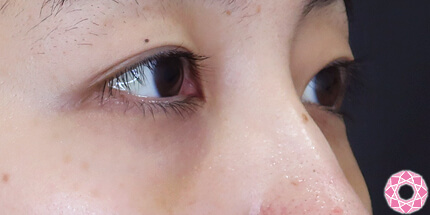 年代：20代 施術名：目の下のふくらみ取り 施術後｜【公式】東京形成美容外科