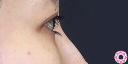 年代：20代 施術名：目の下のふくらみ取り 施術後｜【公式】東京形成美容外科