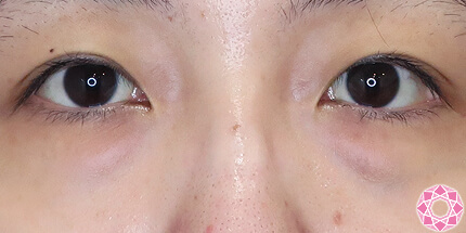 年代：20代 施術名：目の下のふくらみ取り 施術前｜【公式】東京形成美容外科