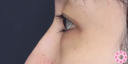 年代：20代 施術名：目の下のふくらみ取り 施術前｜【公式】東京形成美容外科