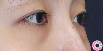 年代：20代 施術名：目の下のふくらみ取り 施術前｜【公式】東京形成美容外科