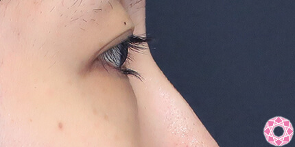 年代：20代 施術名：目の下のふくらみ取り 施術前｜【公式】東京形成美容外科