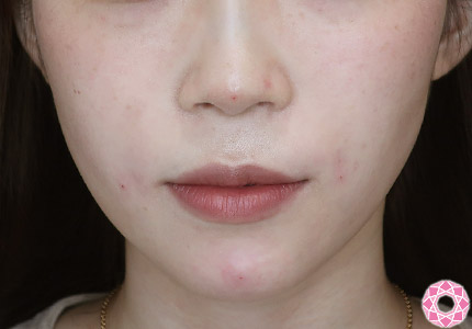 年代：20代 施術名：ジュビダーム 施術後｜【公式】東京形成美容外科