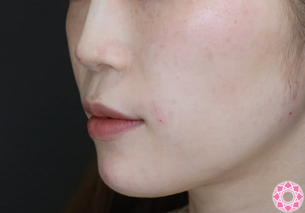 年代：20代 施術名：ジュビダーム 施術後｜【公式】東京形成美容外科