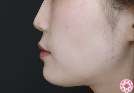 年代：20代 施術名：ジュビダーム 施術後｜【公式】東京形成美容外科