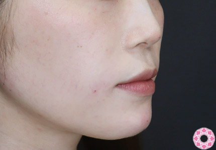 年代：20代 施術名：ジュビダーム 施術後｜【公式】東京形成美容外科