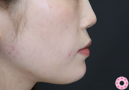 年代：20代 施術名：ジュビダーム 施術後｜【公式】東京形成美容外科