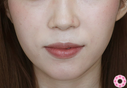 年代：20代 施術名：ジュビダーム 施術前｜【公式】東京形成美容外科