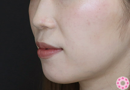 年代：20代 施術名：ジュビダーム 施術前｜【公式】東京形成美容外科