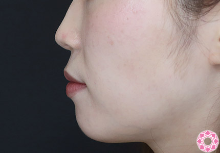 年代：20代 施術名：ジュビダーム 施術前｜【公式】東京形成美容外科