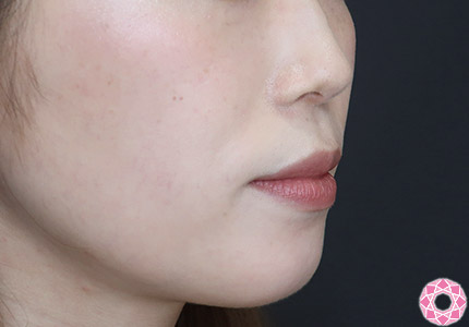 年代：20代 施術名：ジュビダーム 施術前｜【公式】東京形成美容外科