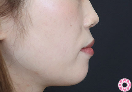 年代：20代 施術名：ジュビダーム 施術前｜【公式】東京形成美容外科